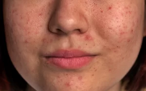 أقوى دواء لحب الشباب من منتجات اي هيرب – افضل 10 من المتجر