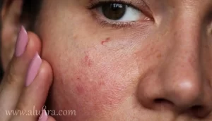 أفضل طريقة لعلاج البشرة الحساسة بشكل فعال