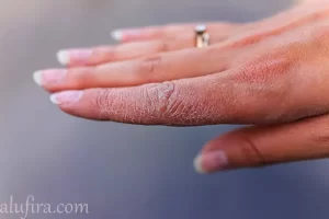 مشاكل البشرة الجافة وأسبابها